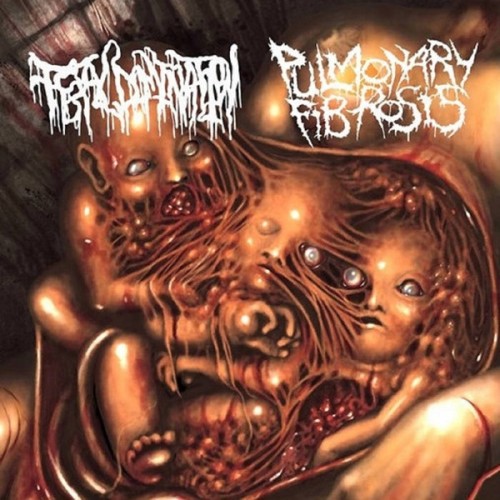 PULMONARY-FIBROSIS-FETAL-DOMINATION-Split-CD-Folia-Goregrind